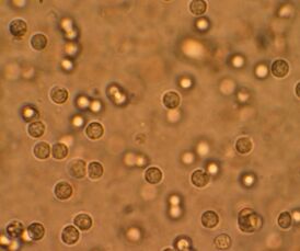 Лейкоциты в моче больного инфекцией мочевыводящих путей, наблюдаемые через микроскопическое исследование