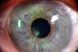 Человеческий глаз с остаточной мембраной зрачка