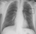 Рентгенограмма грудной клетки, демонстрирующая солитарный лёгочный узел в верхней доле левого лёгкого.