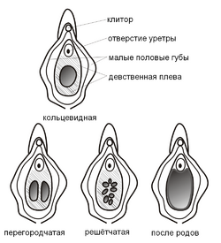 Типы строения девственной плевы человека