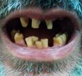 Обесцвеченные зубы