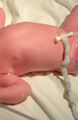 Пластиковый зажим наложенный на пуповину со стороны новорождённого вместо перевязки